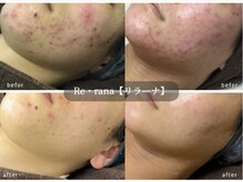 リラーナ(Re rana)