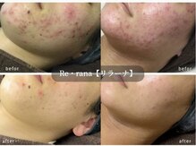 リラーナ(Re rana)