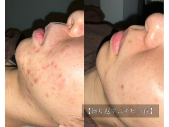 ル シーニュ/プロセルフェイシャル×6回