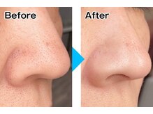 スピカ スターレイビュー(Spica Starry view)/ハイドロフェイシャル１回施術