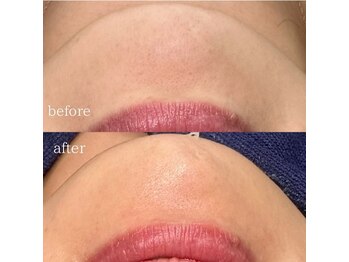 ヒツキ(hituki)/グレーズピール★美肌ピーリング