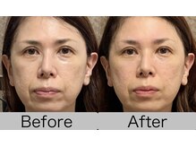 あおき鍼灸整骨院/小顔美容鍼　施術1回効果