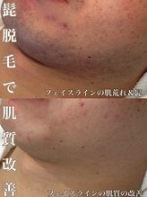 サロン ド マキ(Salon de Maki)/脱毛で肌質改善！？