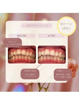 プラスビー 2号店(+b)/ホワイトニングビフォーアフター