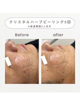 ノドカ 新市街店(NODOKA)/肌トラブル跡のケアに