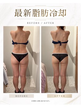 ポノピピ 小倉本店(ponopipi)の写真/メリハリ美ボディへ！脂肪冷却×リポベラで理想のボディライン★口コミ4.9講師在籍の完全個室サロン