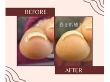 リエル(RIELE)/巻き爪補正☆