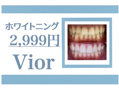 歯のセルフホワイトニング・通いやすい3回照射セット2999円