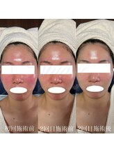 ニュアージュ(Nuage)/赤みの変化・2回施術後の変化