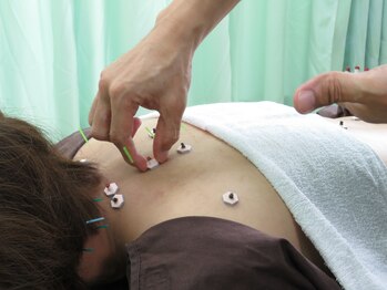ひまわり鍼灸接骨院/お灸施術