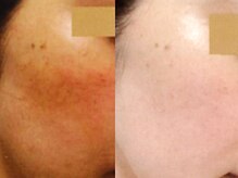 フルリール/【ニキビケアプロテクション】