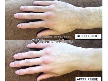 ダイアモンドベリー/手指甲脱毛でモテ度アップ!
