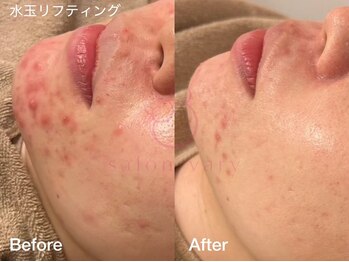 サロンヴェアリー 広尾(salon vary)/ニキビの鎮静#ldm#水玉