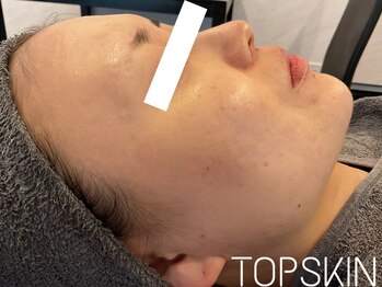 トップスキン 新宿(TOPSKIN)/肌荒れのない健康的なツヤ肌へ☆