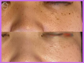 ヴィオール 名古屋栄店(VIOR)/シミ悩みは光Vショット