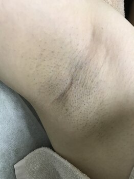 ナノハナ/鹿沼市全身脱毛ナノハナ