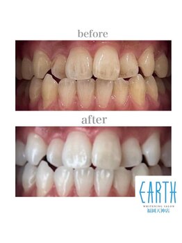 アース 福岡天神店(EARTH)/before　after　【美白】