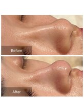 アヴニール 光の森(AVENIR)/毛穴洗浄☆１回の効果