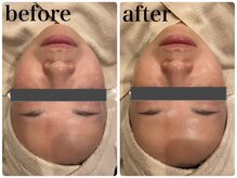 エヌインスキンケアスタジオ 天神店 N-inスキンケアスタジオ/症例【美肌/美白/小顔/毛穴】