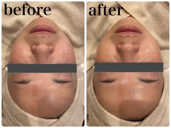 エヌインスキンケアスタジオ 天神店 N-inスキンケアスタジオ/症例【美肌/美白/小顔/毛穴】