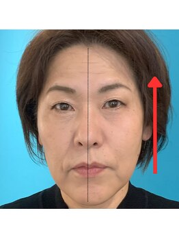 ネクスフィット(Nexfit)/小顔矯正フェイスリフトの効果