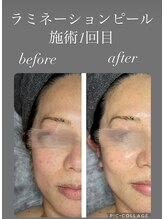 サイ(Sai)/ラミネーションピール