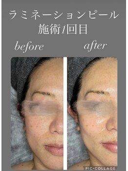 サイ(Sai)/ラミネーションピール