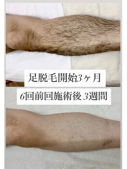 ヴィアージュ/メンズ脱毛