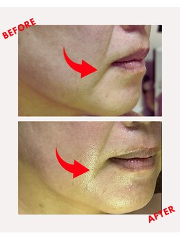 ユーフォリア(Euphoria)/マリオネットラインが!?