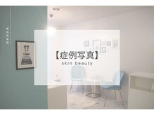 ベル 天王寺(Belle)/ハーブピーリング｜写真