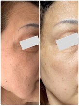 月とルーツ 大阪南堀江(月とroots)/エイジングケア.美白.シミ.しわ