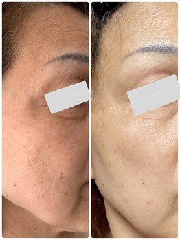 月とルーツ 大阪南堀江(月とroots)/エイジングケア.美白.シミ.しわ