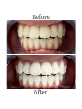 エクシアホワイトニング 相模大野店/ビフォーアフター