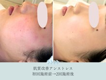 極度の乾燥と赤みで何を塗っても改善しなかった敏感肌が2回で◎