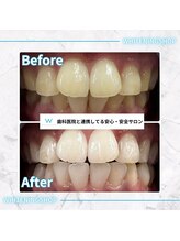 ホワイトニングショップ 太田店/ホワイトニングビフォアフター