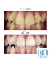 アース 福岡天神店(EARTH)/before　after　【美白】