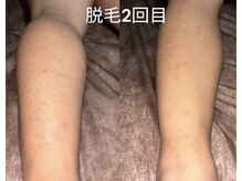 ベルフィオーレ(bel fiore)/メンズ脱毛