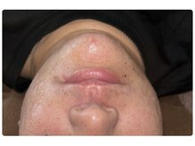 ベルフィオーレ(bel fiore)/髭脱毛　30代男性4回目