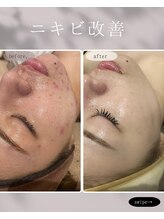 レア(le'a)/ニキビ改善