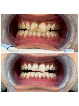 コナホワイトニング 神保町/ホワイトニング