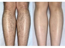 サロン フィオーレ(salon fiore)/メンズ脱毛もお任せください