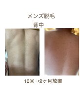 ハロ(Halo)/メンズ脱毛