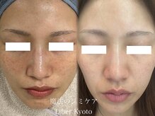 エステティック リベル キョウト 京都駅前店(Esthetic Liber Kyoto)/魔法のシミケア