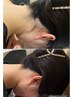 脱毛カウンセリング　何歳からでも始めれます(^^♪
