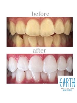アース 福岡天神店(EARTH)/before　after　【美白】