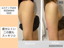 ハピネス(HAPPINESS)/4ステップメニュー　二の腕1回目