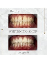 ホワイトニングショップ 尼崎店/セルフホワイトニング1回の効果