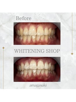 ホワイトニングショップ 尼崎店/セルフホワイトニング1回の効果