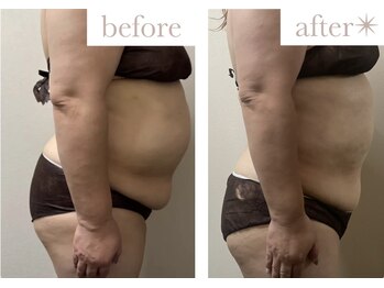 エバーグリーン(Evergreen)/脂肪冷却7回の変化