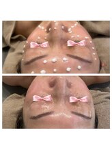 美温(mion)/植えるエクソソーム　メソプロ